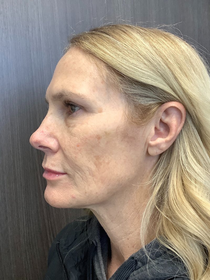 Fillers Before & After Gallery - Patient 161437137 - Image 8