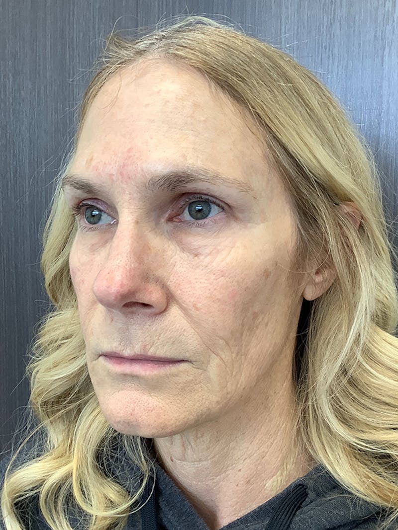 BOTOX Before & After Gallery - Patient 161437142 - Image 5