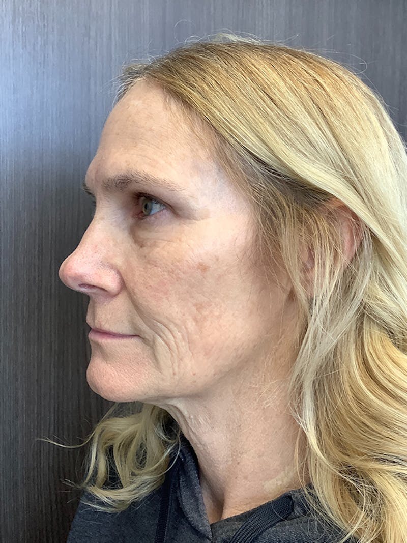 BOTOX Before & After Gallery - Patient 161437142 - Image 7