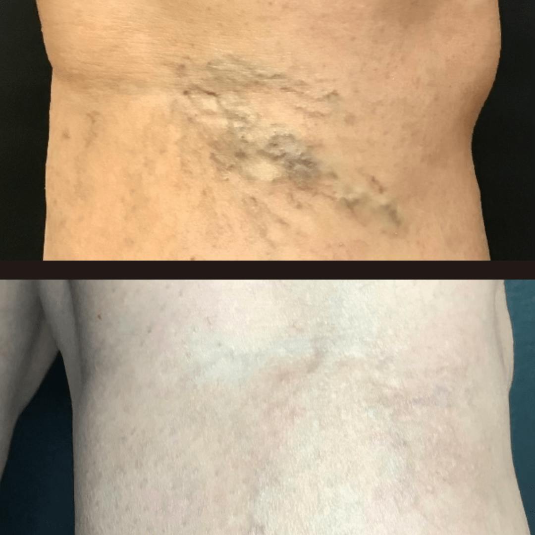Laser Vein Treatment Before & After Gallery - Patient 162901398 - Image 1