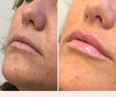 Lip Filler Before & After Gallery - Patient 162901432 - Image 1
