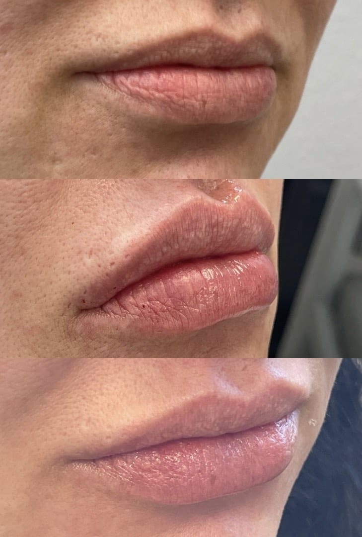Lip Filler Before & After Gallery - Patient 162901433 - Image 1