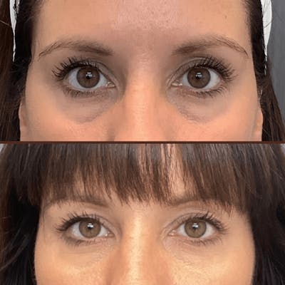 Tear Trough Filler Before & After Gallery - Patient 162901445 - Image 1