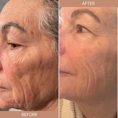 Skincare Before & After Gallery - Patient 162901451 - Image 1