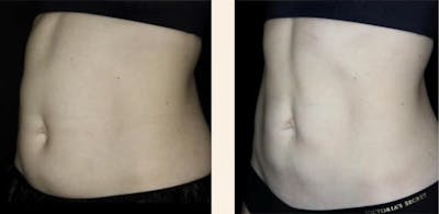 CoolSculpting Before & After Gallery - Patient 162901452 - Image 1