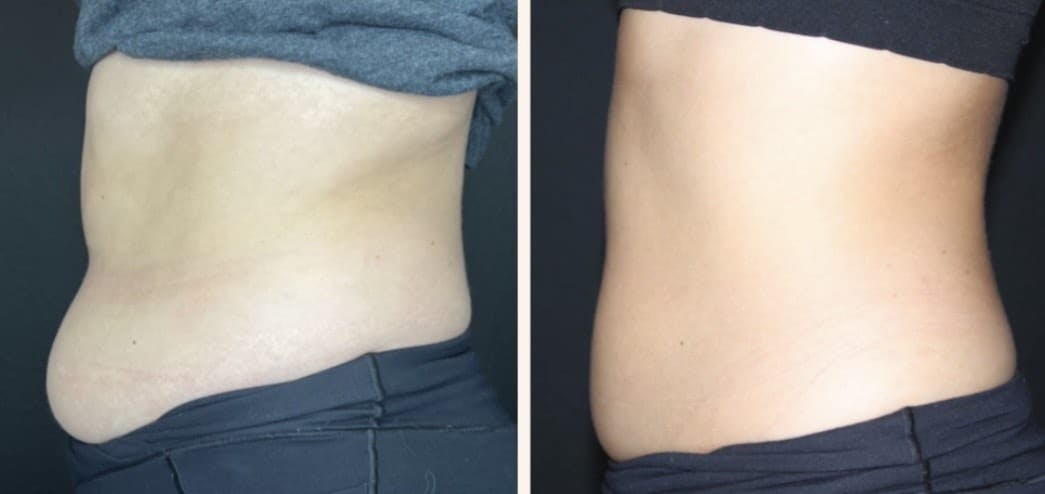 CoolSculpting Before & After Gallery - Patient 162901453 - Image 1