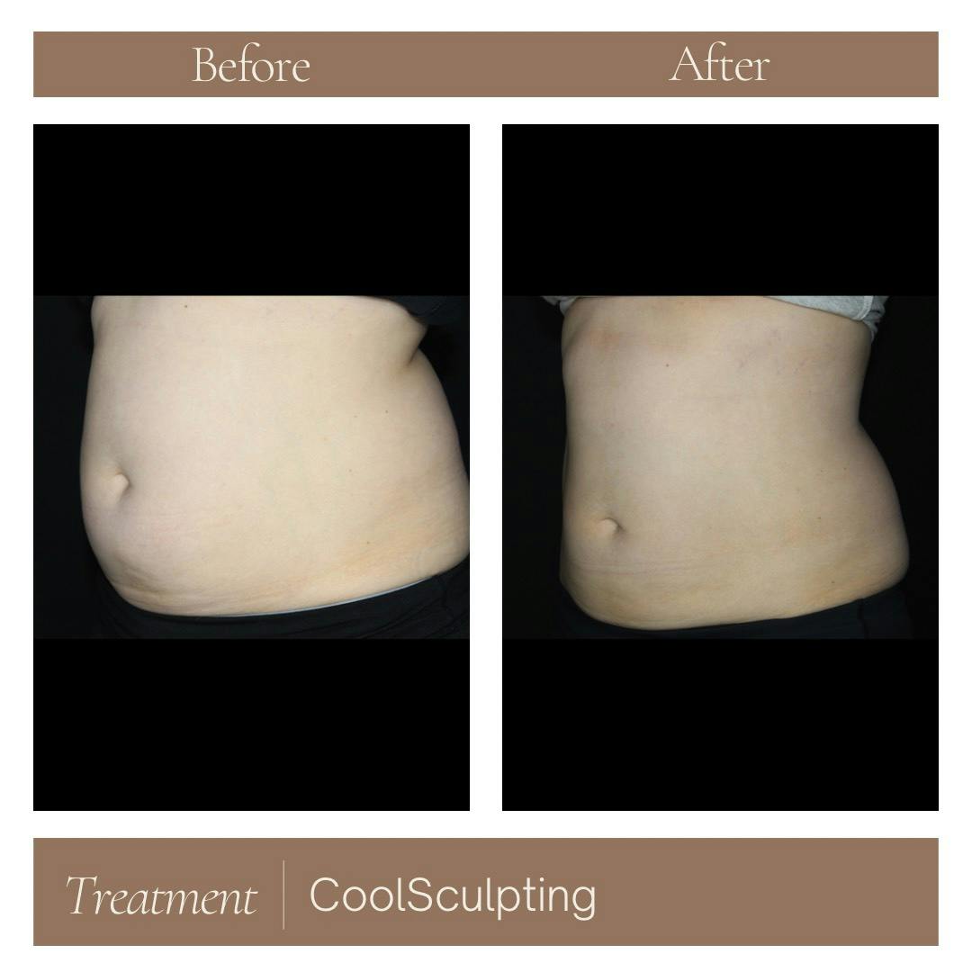 CoolSculpting Before & After Gallery - Patient 177056300 - Image 2