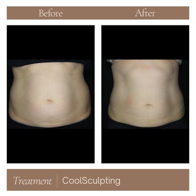 CoolSculpting Before & After Gallery - Patient 177056300 - Image 1