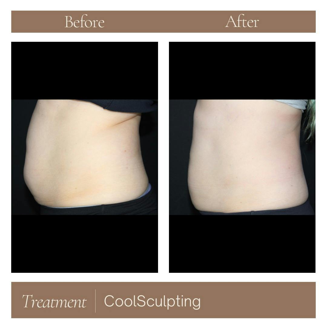 CoolSculpting Before & After Gallery - Patient 177056300 - Image 3