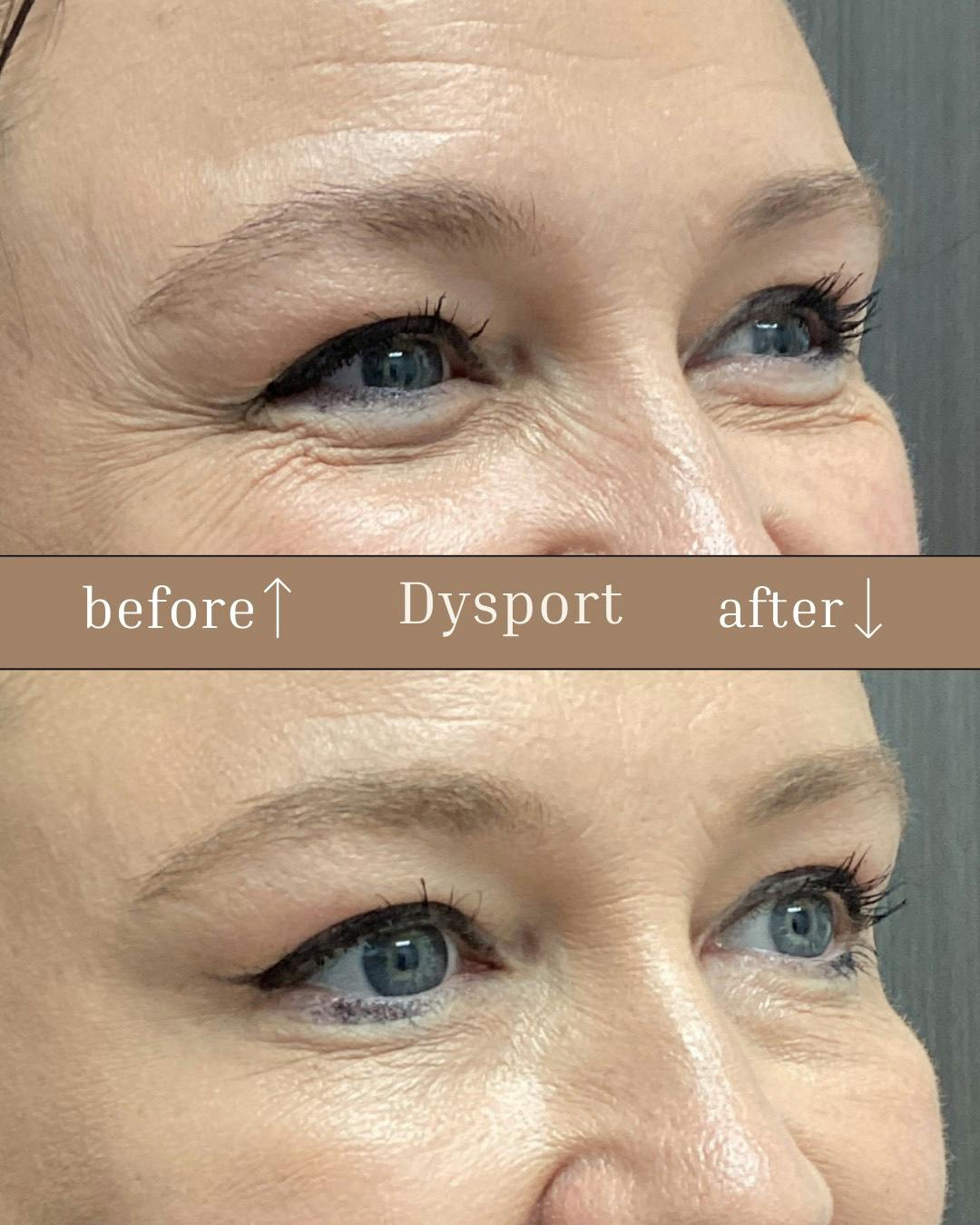 Dysport Before & After Gallery - Patient 177056303 - Image 1