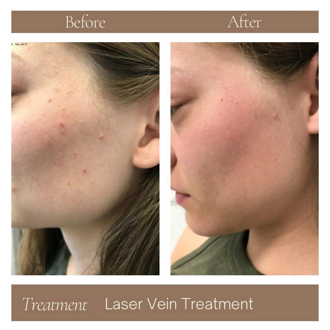 Laser Vein Treatment Before & After Gallery - Patient 177056305 - Image 1