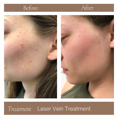 Laser Vein Treatment Before & After Gallery - Patient 177056305 - Image 1