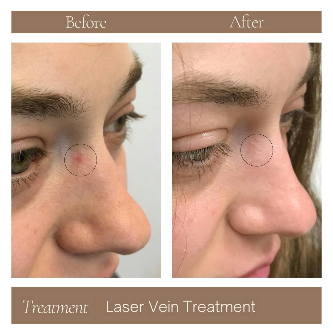 Laser Vein Treatment Before & After Gallery - Patient 177056306 - Image 1