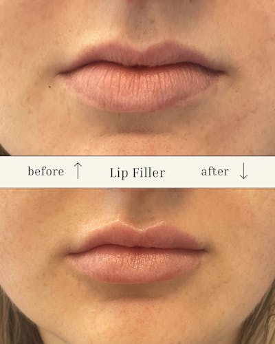 Lip Filler Before & After Gallery - Patient 177056307 - Image 1