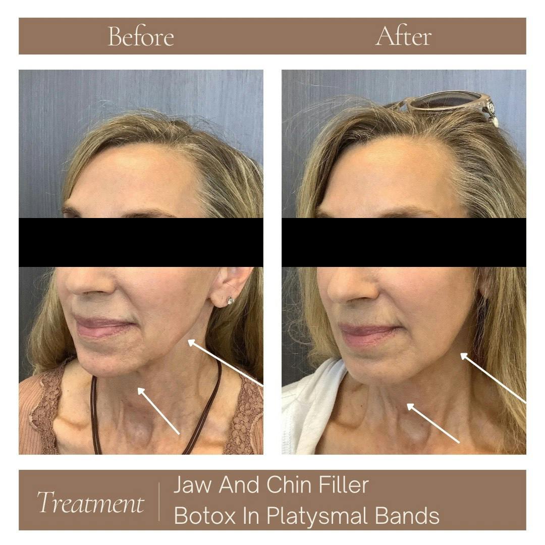 BOTOX Before & After Gallery - Patient 189119396 - Image 1