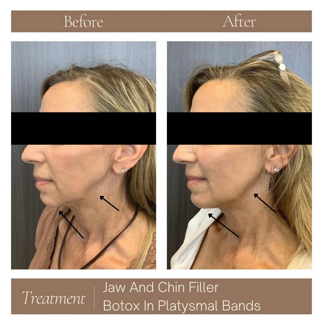 Fillers Before & After Gallery - Patient 189119398 - Image 2