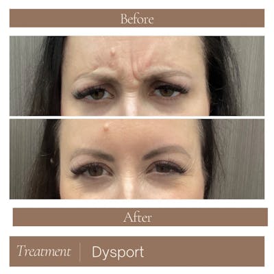 Dysport Before & After Gallery - Patient 228020 - Image 1