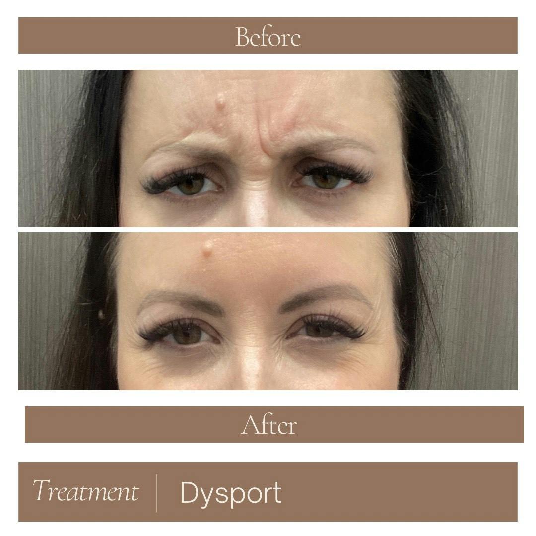 Dysport Before & After Gallery - Patient 250126 - Image 1