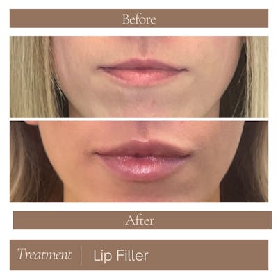 Lip Filler Before & After Gallery - Patient 321282 - Image 1