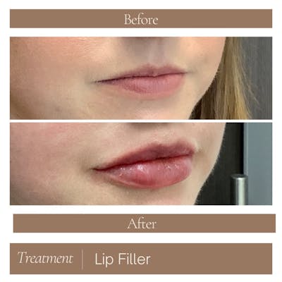Lip Filler Before & After Gallery - Patient 407702 - Image 1