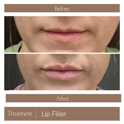 Lip Filler Before & After Gallery - Patient 106280 - Image 1