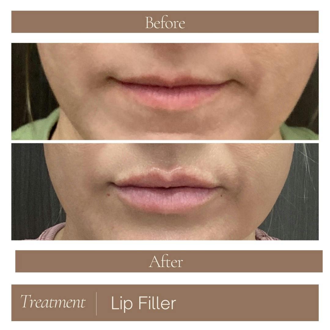 Lip Filler Before & After Gallery - Patient 106280 - Image 1