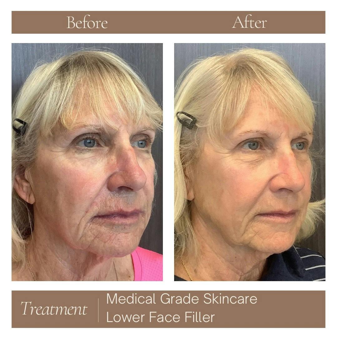 Facial Rejuvenation Before & After Gallery - Patient 403706 - Image 2