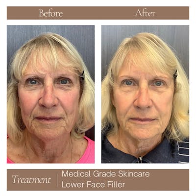 Facial Rejuvenation Before & After Gallery - Patient 403706 - Image 1