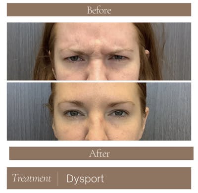 Dysport Before & After Gallery - Patient 264976 - Image 1