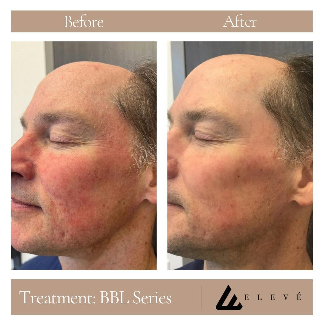 Facial Rejuvenation Before & After Gallery - Patient 226082 - Image 1