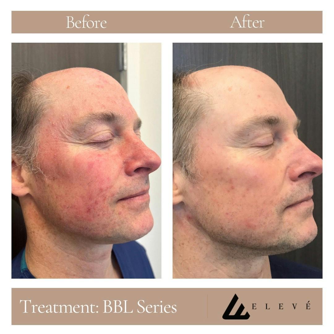 Facial Rejuvenation Before & After Gallery - Patient 226082 - Image 2