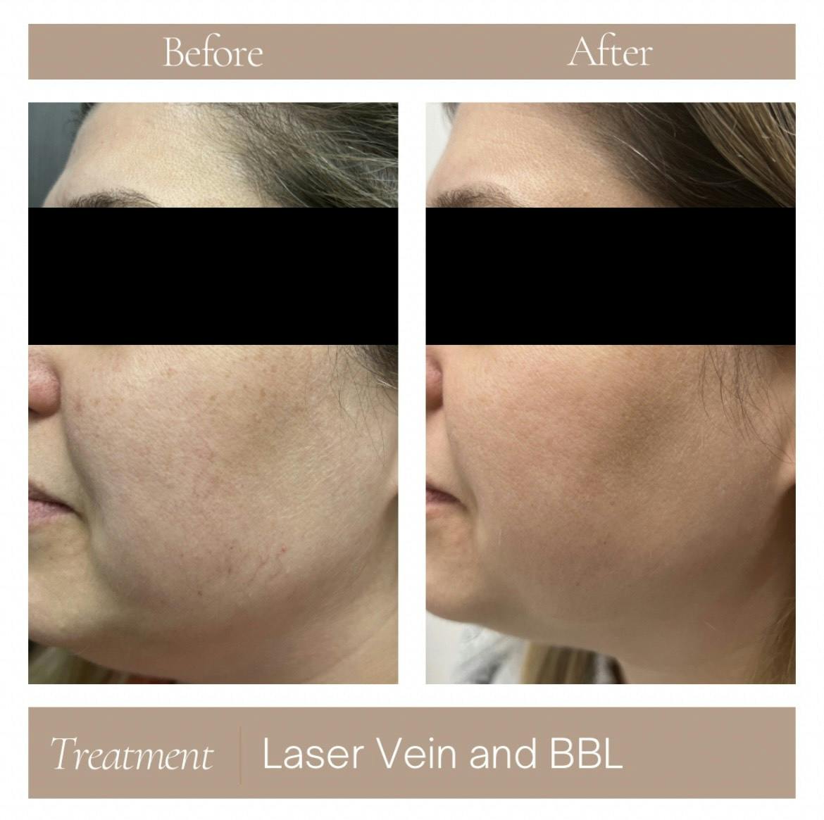 Laser Vein Treatment Before & After Gallery - Patient 291741 - Image 1