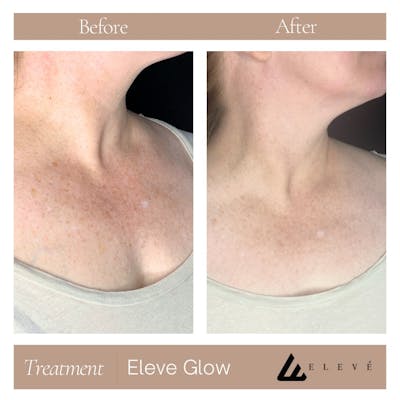 Eleve Glow Before & After Gallery - Patient 138788 - Image 1