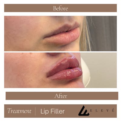 Lip Filler Before & After Gallery - Patient 789574 - Image 1