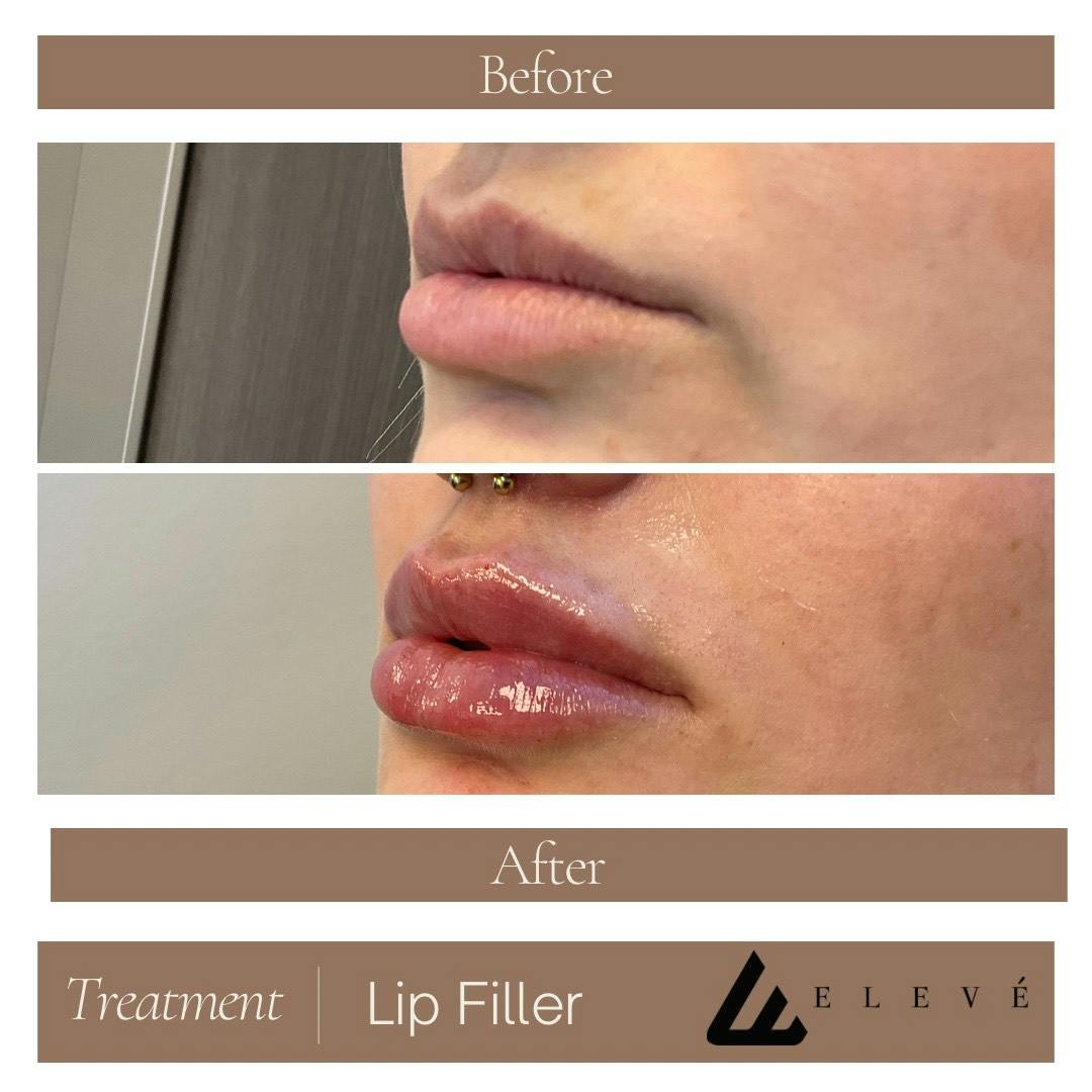 Lip Filler Before & After Gallery - Patient 789574 - Image 2