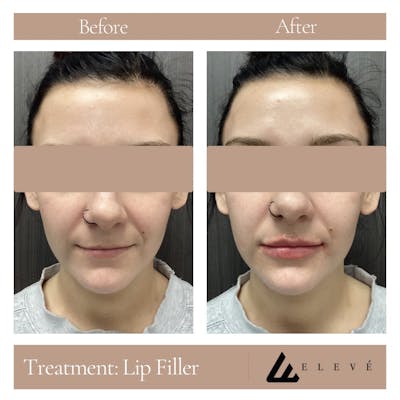 Lip Filler Before & After Gallery - Patient 109313 - Image 1