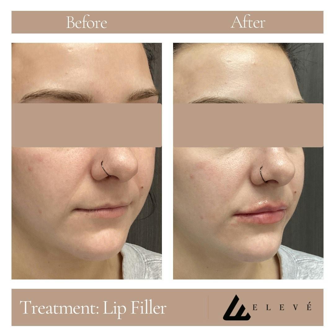 Lip Filler Before & After Gallery - Patient 109313 - Image 2