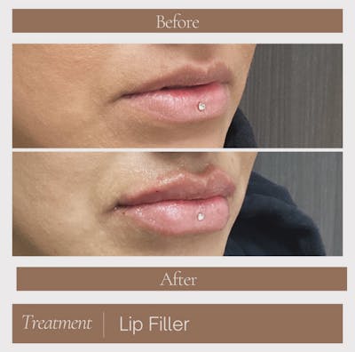 Lip Filler Before & After Gallery - Patient 168840 - Image 1