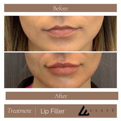 Lip Filler Before & After Gallery - Patient 358549 - Image 1