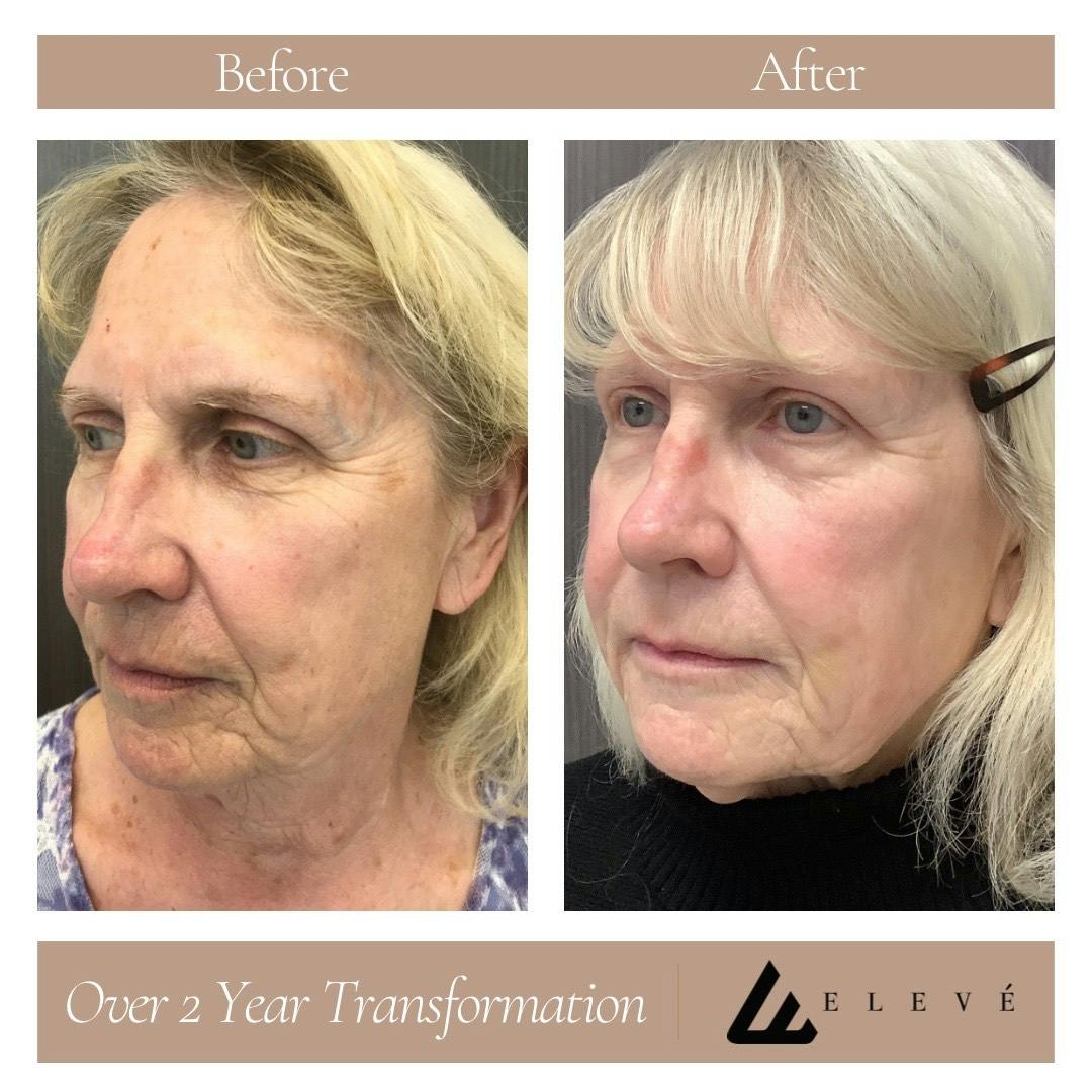 Skincare Before & After Gallery - Patient 360408 - Image 2