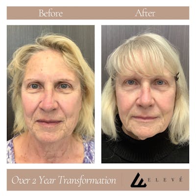 Skincare Before & After Gallery - Patient 360408 - Image 1