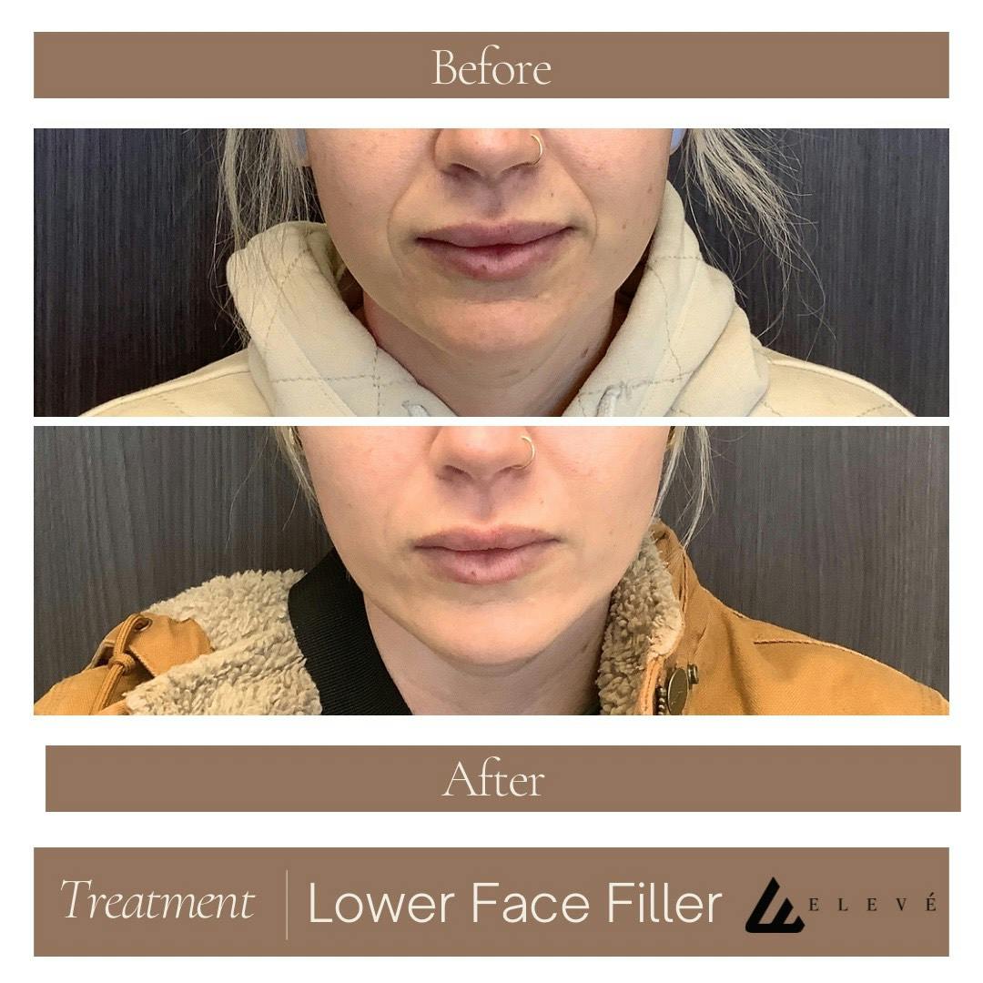 Fillers Before & After Gallery - Patient 434983 - Image 1