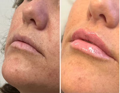 Fillers Before & After Gallery - Patient 153504 - Image 1