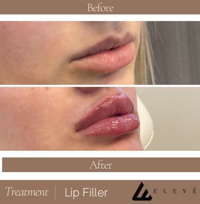 Fillers Before & After Gallery - Patient 316841 - Image 1
