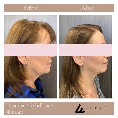 Injectables Before & After Gallery - Patient 125573 - Image 1