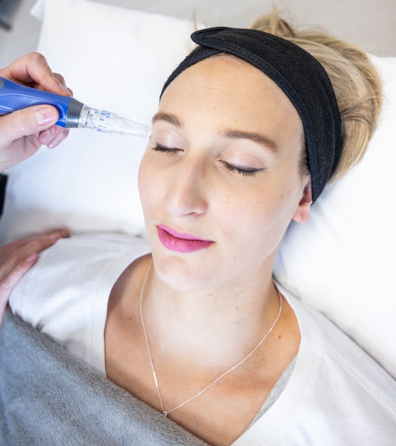 Women receiving microneedling treatment