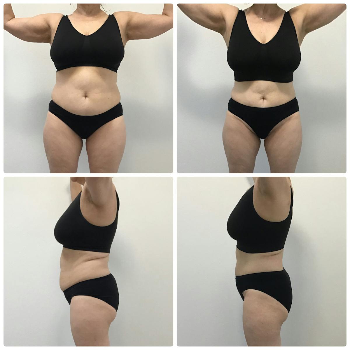 Semaglutide Before & After Gallery - Patient 186756377 - Image 1