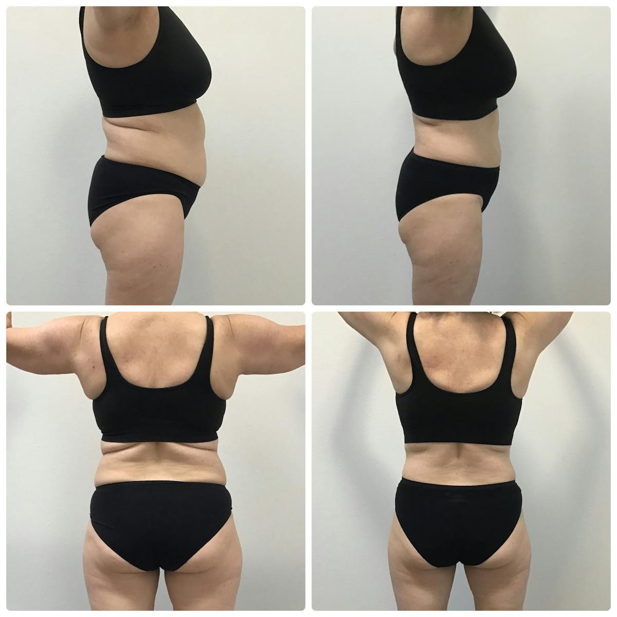 Semaglutide Before & After Gallery - Patient 186756377 - Image 3