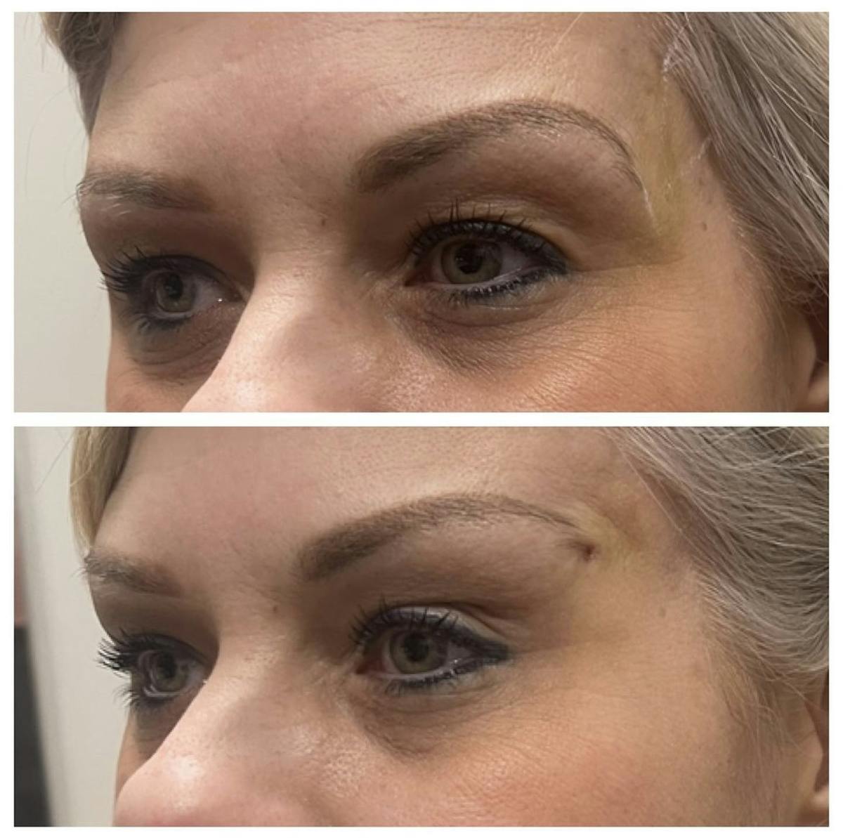 PDO Threads Before & After Gallery - Patient 186759221 - Image 1