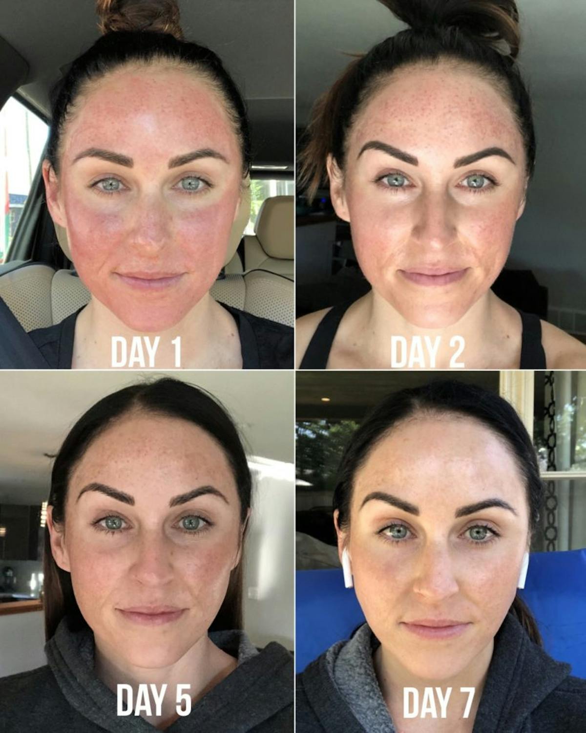 Microneedling Before & After Gallery - Patient 187060677 - Image 1